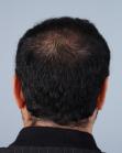 After Hair Transplant&nbsp;2 Sessions (Areas)
